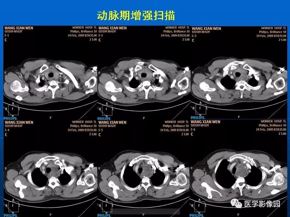 少見縱隔腫瘤等你分析讀片專欄836期