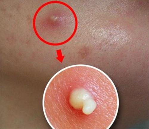 挤完痘痘后又复发的人你皮肤可能感染了螨虫3迹象帮你自查