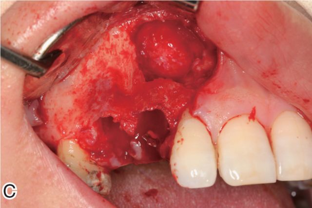 颌骨囊肿中牙和骨组织的处理对策王恩博医师