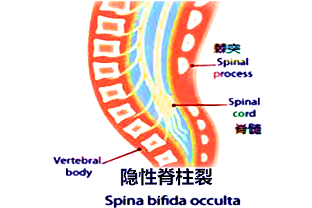 这么可怕的显性脊柱裂有什么常见症状?