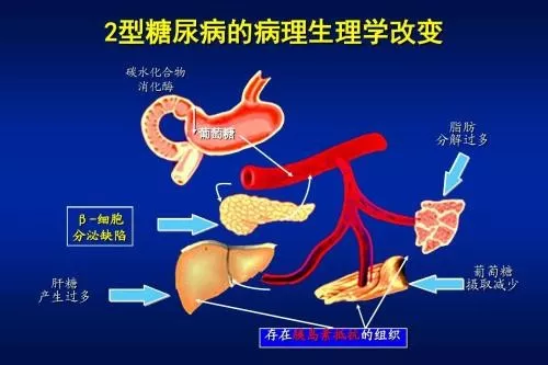 经典病例|糖尿病患者高烧一周不退,医院拒绝接诊,她该何去何从?