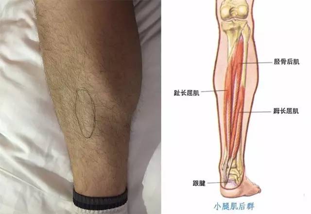 跟腱是哪到哪的距离图片