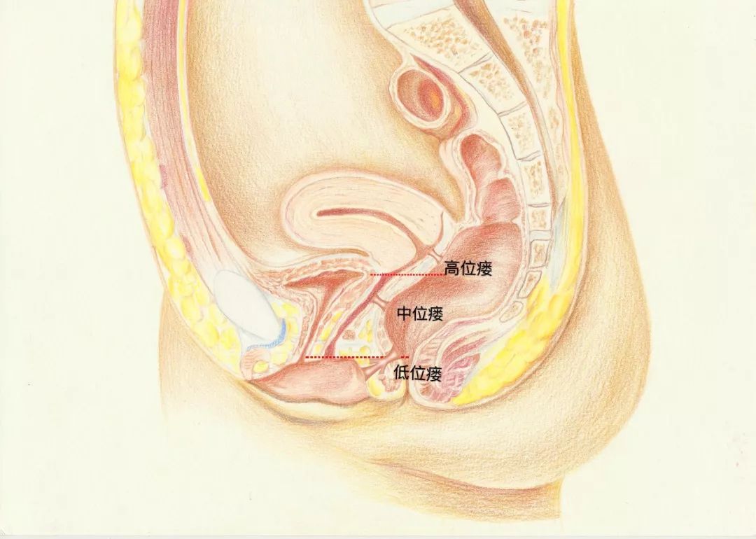 女性直肠阴瘘图片