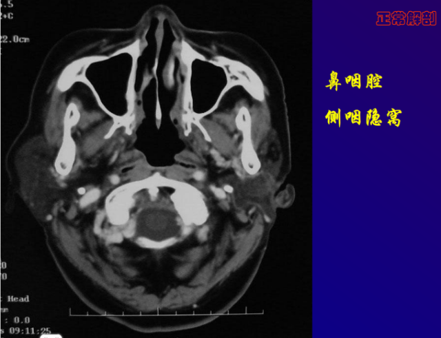 鼻咽癌的ct诊断