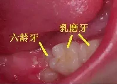 做了窩溝封閉就沒有蛀牙這句話騙了多少人