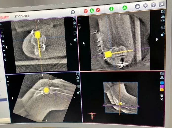 北京積水潭醫院創傷骨科蔣協遠教授團隊在世界上率先完成肘關節雙平面