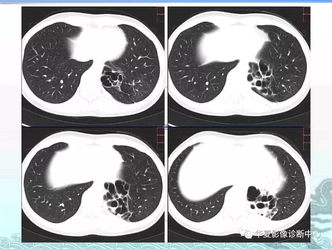 肺隔离症ct图片