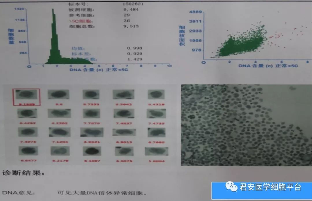 检查分析dna倍体查见异型细胞,最后结果待细胞块及免疫组织化学检查.