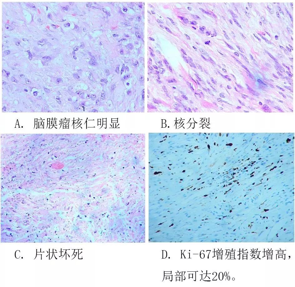 常規病理提示:(左頂矢狀竇旁)腦膜瘤,伴大片壞死,核分裂1個/10hpf,局