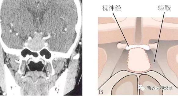 鞍區常見2種腫瘤ct表現