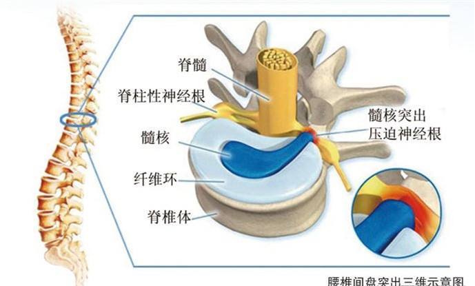 腰椎间盘突出都需要做手术吗