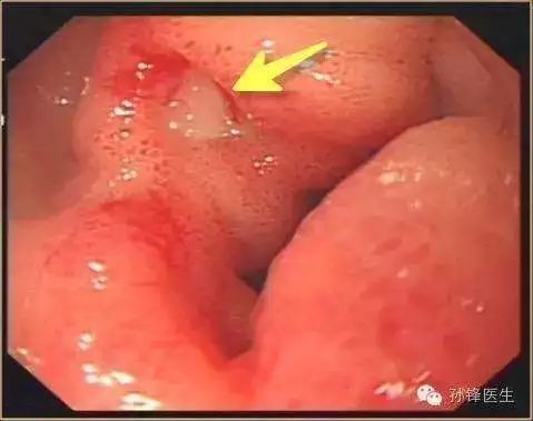 2,急性糜烂性胃炎主要症状:胃黏膜病变主要表现为充血,水肿,粘液分泌