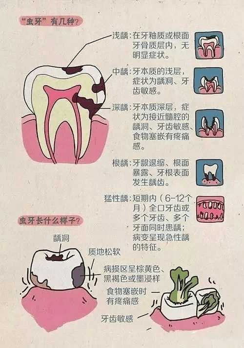 蟲牙裡面是真的有蟲蟲牙為什麼總是發生在大牙上