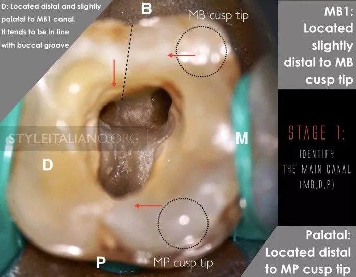 上颌第二磨牙根管口图图片