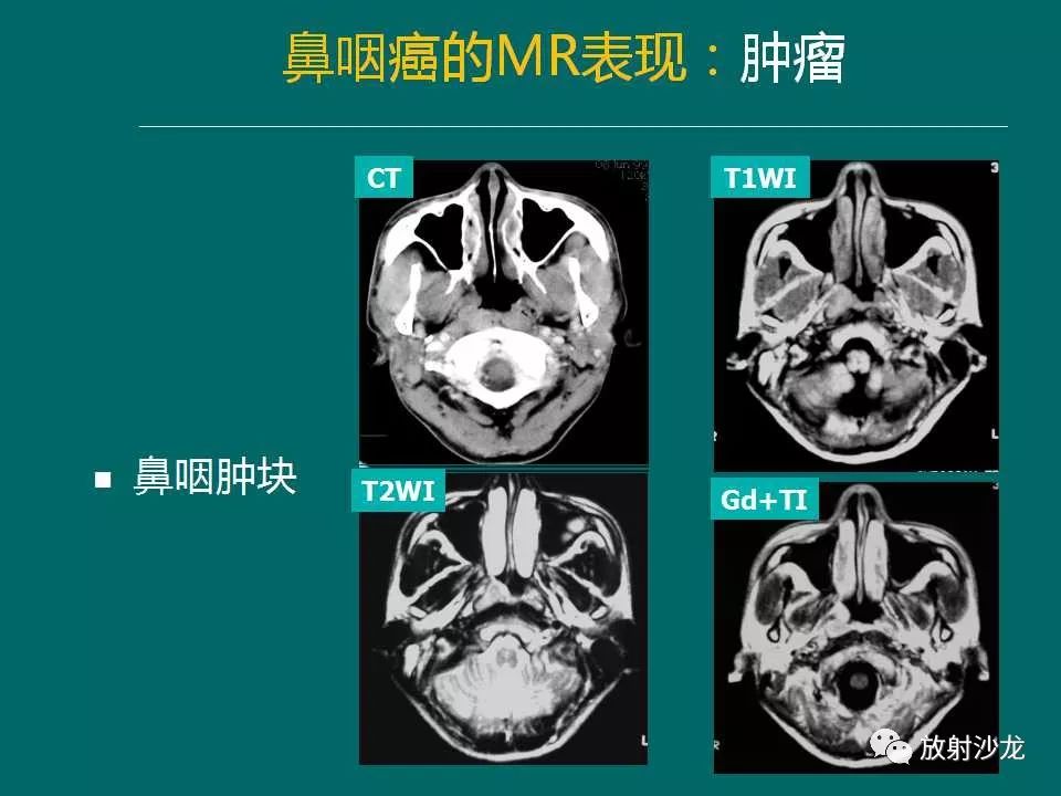 鼻咽癌的mri诊断