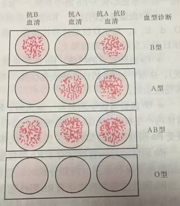 血型鉴定凝集反应图片图片