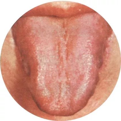 气郁体质舌苔图片图片