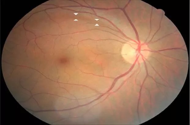 视网膜有髓神经纤维图片