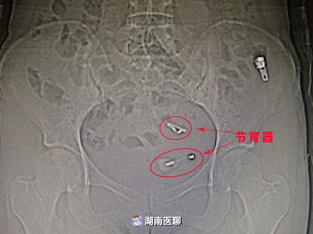 病例3:43岁患者姚女士,节育器异位至宫腔外,通过腹腔镜将节育器成功