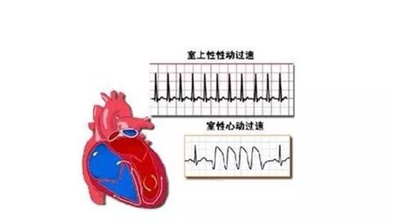 心动过速的原因及治疗图片