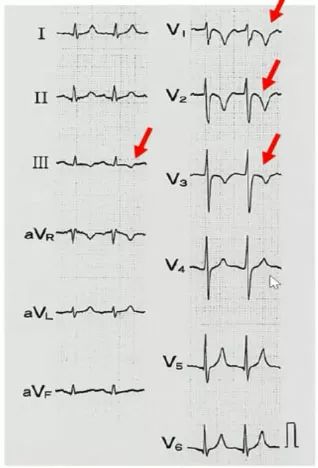 肺栓塞的心电图图片图片