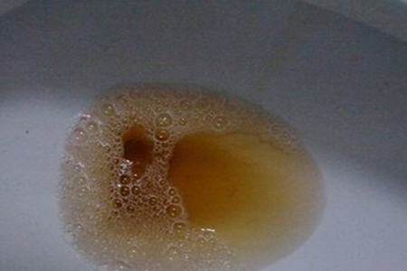 1,尿液呈深黄色(浓茶色):肝脏可能出现了问题但如果你的晨尿颜色是