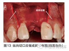 口腔種植手術學圖解組織切開與翻瓣