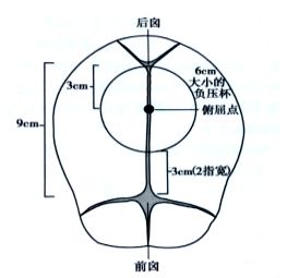 胎吸法图片