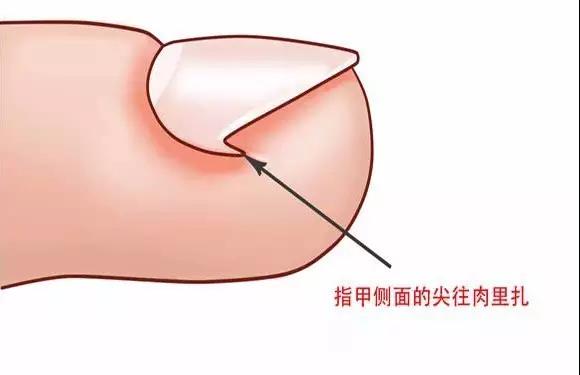 终于,我自己解决了嵌甲