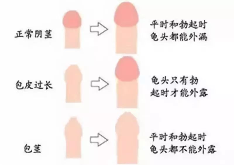 如果勃起龟头仍不能外露称之为包茎,用手都不能将包皮退下露出龟头的