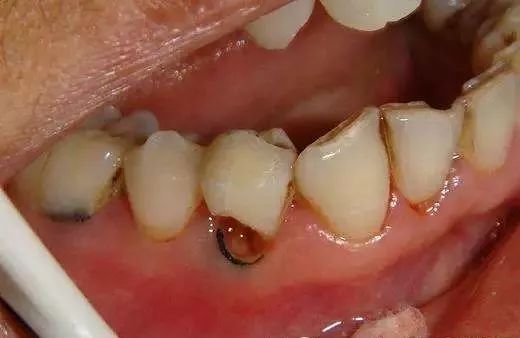 【微健康】中老年人容易得的4种牙病!专家教你日常如何预防