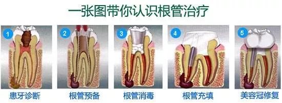 根管治疗要几次图片