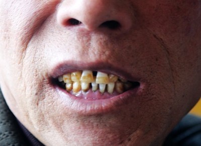但是随着年龄的增长,牙齿慢慢变黄或者发暗,而有些人牙齿本身偏黄或有
