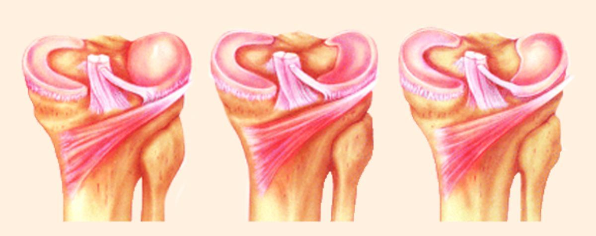 膝关节半月板什么形状图片