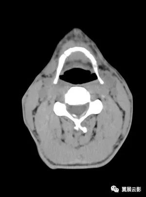甲状舌管囊肿ct图片图片