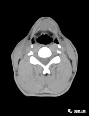 甲状舌管囊肿ct图片图片