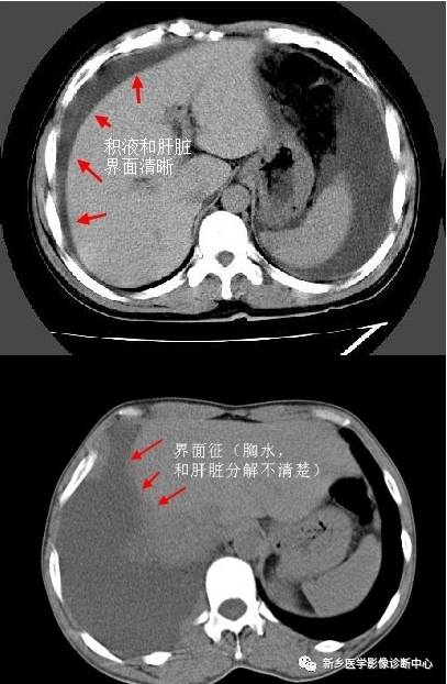 四句话告诉你如何鉴别胸腹水