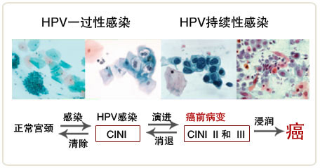 預防hpv宮頸癌營養學上的一個方子照著做癌細胞都顫抖