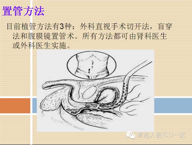 ppt:腹膜透析的护理