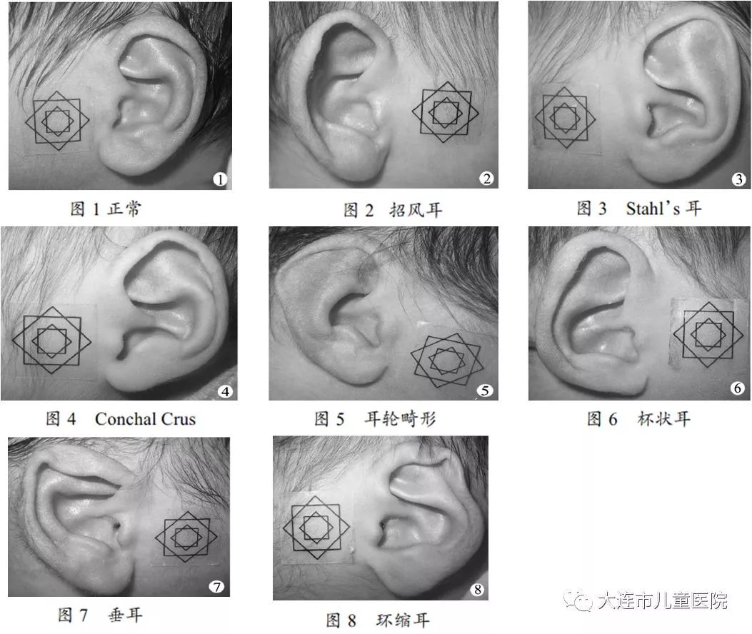 兒醫特色不用手術治療小兒先天性耳廓發育畸形