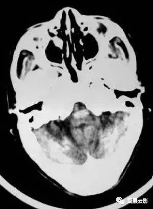 齿状核钙化影像图片图片