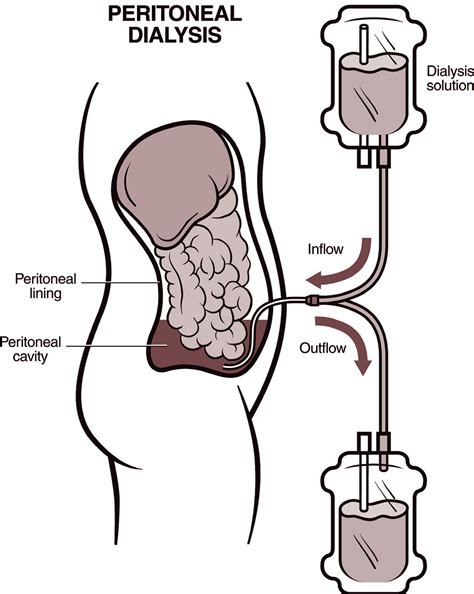 peritoneal cavity图片