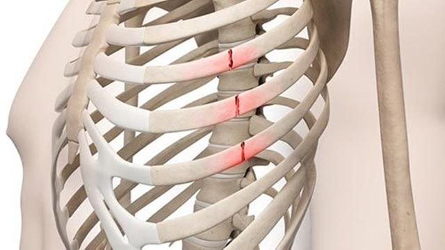 很多严重的病症状甚至癌症,都会有表现出肋骨疼痛的迹象,所以出现肋骨