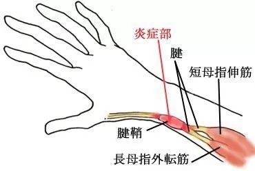 拇指腱鞘炎针刀示意图图片