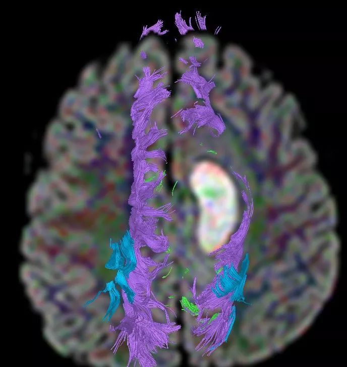 精選丨腦出血神經纖維束受損dti精準診斷分析