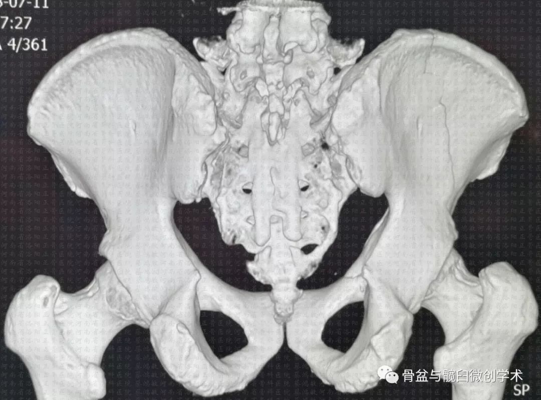 髖臼前柱ota62a32骨折的標準化微創手術治療