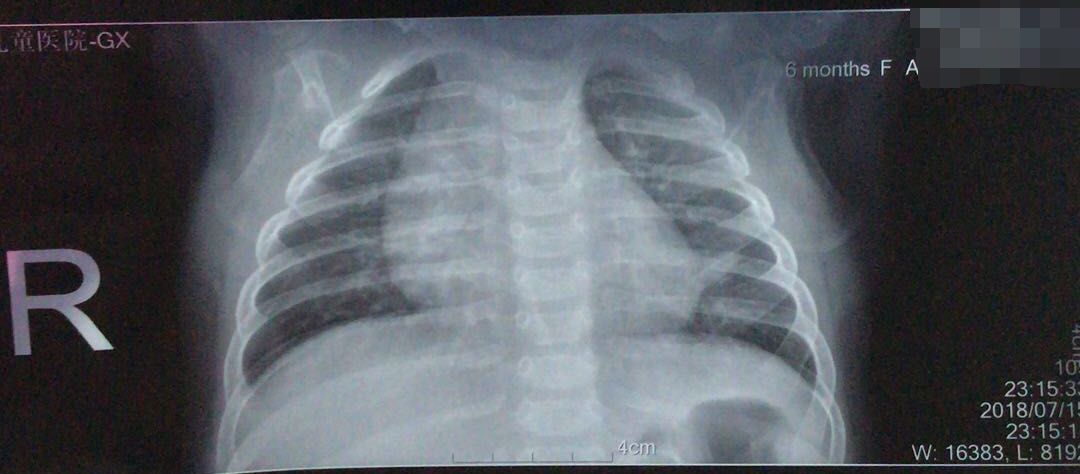 宝宝不咳嗽但胸片显示肺部全是痰的原因是什么？