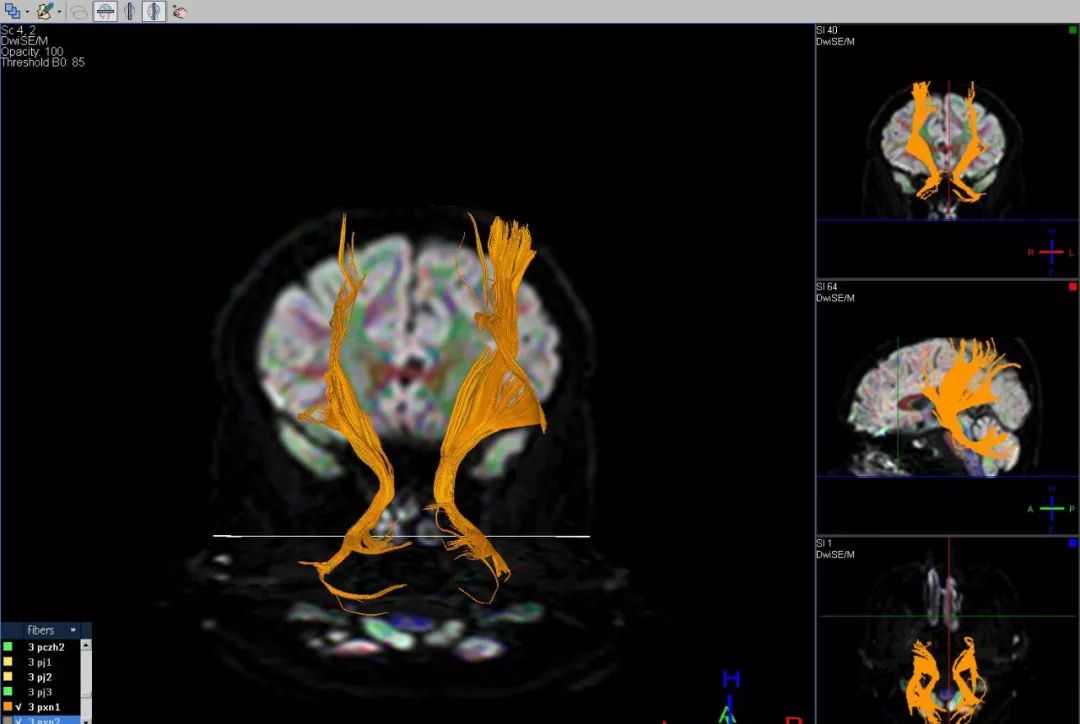 精選丨腦出血神經纖維束受損dti精準診斷分析