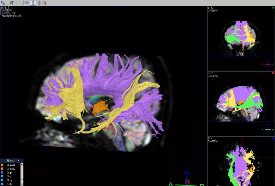 精選丨腦出血神經纖維束受損dti精準診斷分析