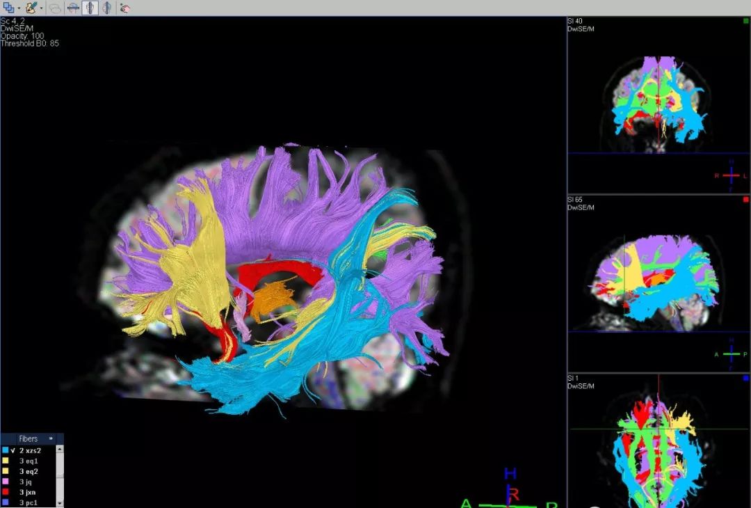 精選丨腦出血神經纖維束受損dti精準診斷分析